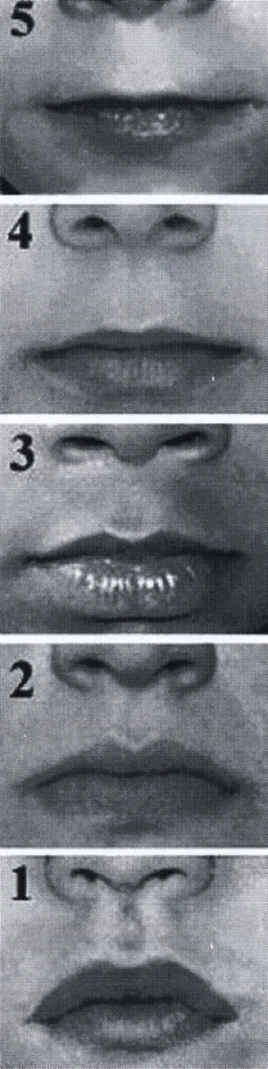Figuur 1. Dysmorfieën van lip en bovenlip bij foetale alcoholsyndromen, met gradering