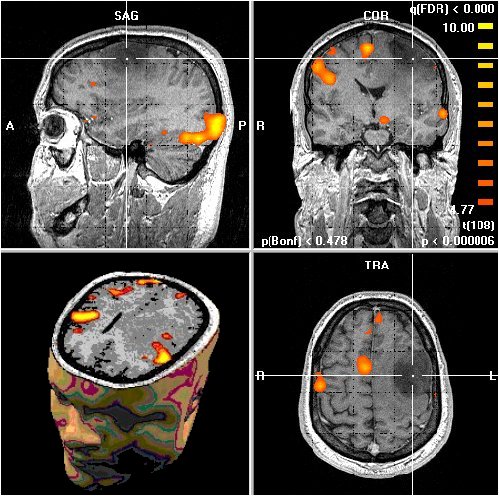 Figuur 5. fMRI van de hersenen