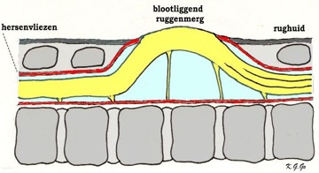 Figuur 2. Schematische weergave van een meningomyelokèle