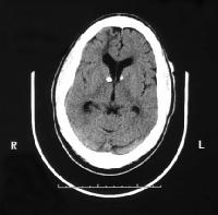 Figuur 1b. CT scan. Verkalkte noduli, subependymaal