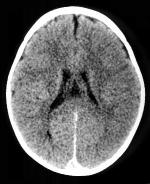 Figuur 2. CT scan van normale hersenen.