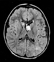 Figuur 2. MRI, T1 gewogen. Afwijking zoals voorkomend bij subependymale reuscel tumor