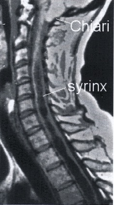 Figuur 3. MRI van Chiari malformatie en syrinx in het ruggenmerg