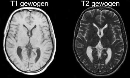 Figuur 3. MRI van normale hersenen