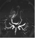 Figuur 4 MRI angiogram van hersenvaten