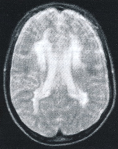 Figuur 5. MRI hersenen