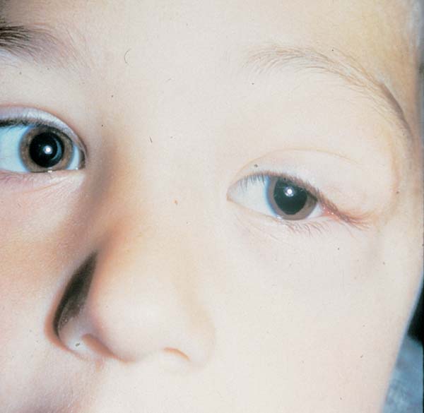 Figuur 5b. Plexiform neuribroom in de linker oogkas bij een jong kind
