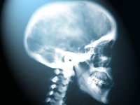 Figuur 1. Röntgenfoto schedel en halswervelkolom